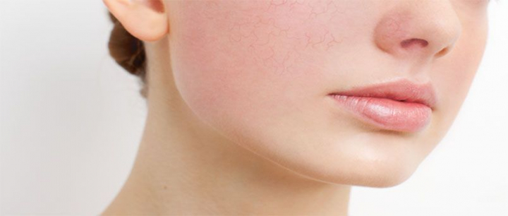 Cum să scapi de roșeața pielii, cu ajutorul unor sfaturi simple de urmat
Cum să scapi de roșeața pielii, cu ajutorul unor sfaturi simple de urmat