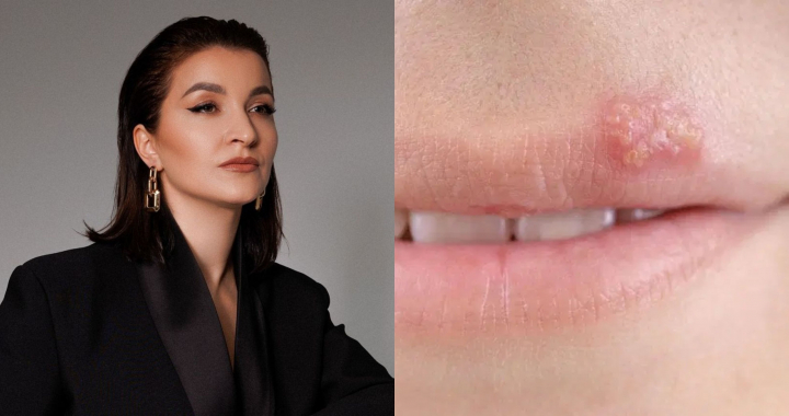 Cauzele mai puțin știute ale apariției herpesului! Perspectivele psihologului Lorina Buga Cauzele mai puțin știute ale apariției herpesului! Perspectivele psihologului Lorina Buga