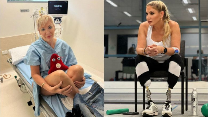 O femeie a fost în comă două săptămâni, a suferit 47 de operații și și-a pierdut ambele picioare de la o mușcătură de țânțar - FOTO O femeie a fost în comă două săptămâni, a suferit 47 de operații și și-a pierdut ambele picioare de la o mușcătură de țânțar - FOTO