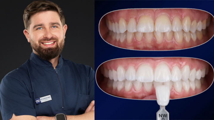 Albirea Dentară - Da sau Nu? Tot ce trebuie să știi despre această procedură. Vladislav Crilic, stomatolog: „Cele mai comune reacții adverse sunt sensibilitatea dentară și iritația gingivală” Albirea Dentară - Da sau Nu? Tot ce trebuie să știi despre această procedură. Vladislav Crilic, stomatolog: „Cele mai comune reacții adverse sunt sensibilitatea dentară și iritația gingivală”