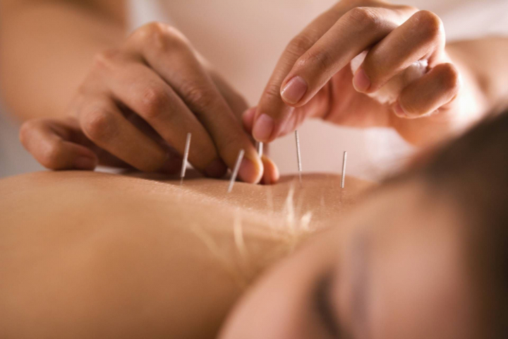 Acupunctura este cheia către echilibrul perfect între corp și minte. Ce beneficii are și pentru cine este recomandată, află astăzi, la O Seară Perfectă - VIDEO