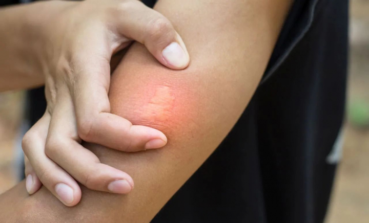 Căpușe, albine, țânțari și alte insecte: cum ne protejăm de înțepături și mușcături - VIDEO Căpușe, albine, țânțari și alte insecte: cum ne protejăm de înțepături și mușcături - VIDEO