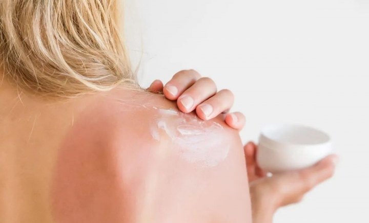 Cum tratăm arsurile solare? Nadejda Dolma, medic dermatolog: „Dacă la început este doar o roșeață, atunci sunt binevenite cremele ce conțin...” - VIDEO Cum tratăm arsurile solare? Nadejda Dolma, medic dermatolog: „Dacă la început este doar o roșeață, atunci sunt binevenite cremele ce conțin...” - VIDEO