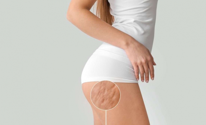 E normal sau nu să ai celulită? Victoria Gorbenco, medic dermatolog: „Majoritatea femeilor, peste 90% au această particularitate a pielii” - VIDEO E normal sau nu să ai celulită? Victoria Gorbenco, medic dermatolog: „Majoritatea femeilor, peste 90% au această particularitate a pielii” - VIDEO