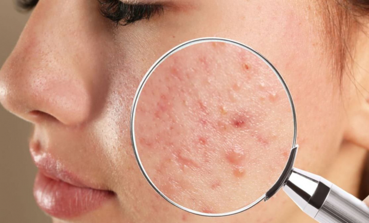 Dermatologul Victoria Gorbenco demontează miturile despre acnee: „Formele de acnee severă, cu noduli, cu chisturi nu se tratează cu rutină de îngrijire, cu un produs cu azelaic sau cu o cremuță” - VIDEO Dermatologul Victoria Gorbenco demontează miturile despre acnee: „Formele de acnee severă, cu noduli, cu chisturi nu se tratează cu rutină de îngrijire, cu un produs cu azelaic sau cu o cremuță” - VIDEO