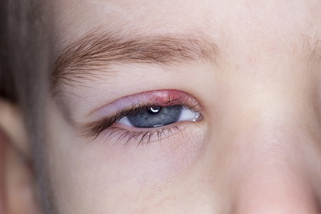 Infectia la ochi sau ulciorul. Care sunt cauzele si cum se trateaza acesta - FOTO Infectia la ochi sau ulciorul. Care sunt cauzele si cum se trateaza acesta - FOTO