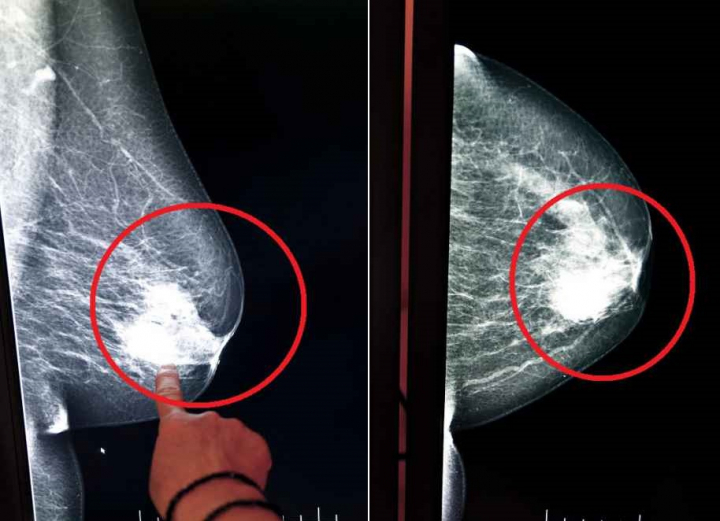 Cum iti dai seama daca un nodul la san e periculos sau nu? Detaliul la care trebuie sa atragi atentia - FOTO