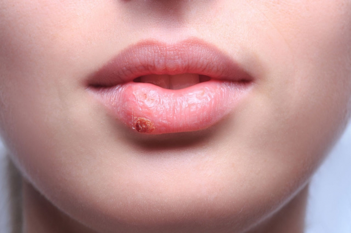 9 din 10 oameni sunt purtatori al virusului herpetic. Cele 5 lucruri pe care trebuie sa le stii daca il ai - FOTO 9 din 10 oameni sunt purtatori al virusului herpetic. Cele 5 lucruri pe care trebuie sa le stii daca il ai - FOTO