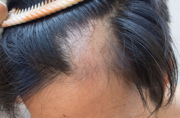 Caderea parului poate avea un impact major asupra fiecaruia dintre noi. Alopecia: simptome, cauze si tratament - FOTO