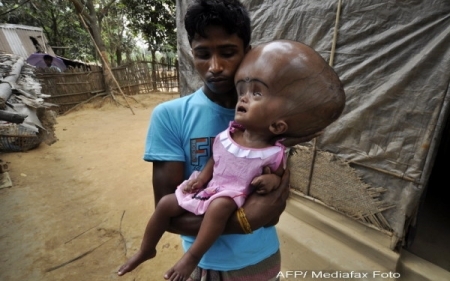 O fetita din India sufera de o boala groaznica! "Arata ca un extraterestru" - FOTO O fetita din India sufera de o boala groaznica! "Arata ca un extraterestru" - FOTO