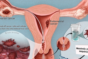 Cancerul ovarian: 6 informatii importante care-ti pot salva viata Cancerul ovarian: 6 informatii importante care-ti pot salva viata