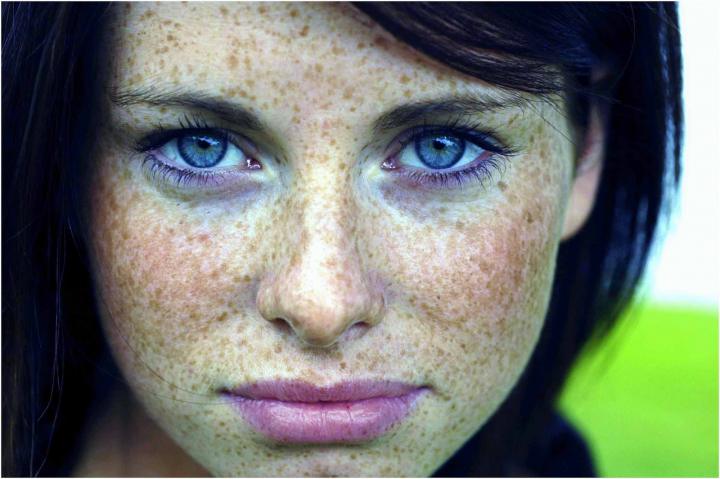 Produse pe care le ai in bucatarie: Cum sa scapi de pistrui intr-un mod natural