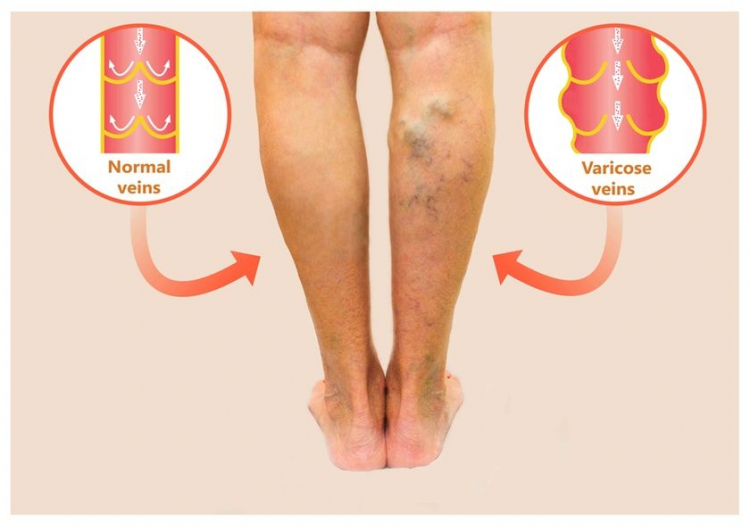 tratamentul venelor varicoase asupra picioarelor de injectare capacele elastice varicoase