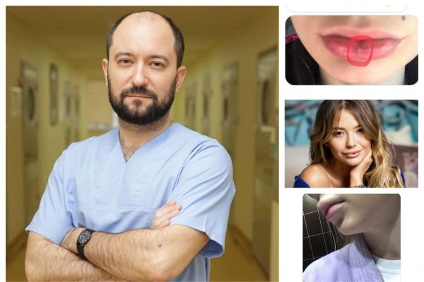 Scandalul buzelor din plastic! Medicul Eugeniu Gorosenco atentioneaza: "Dupa injectarea produselor sintetice, organismul apreciaza preparatul ca unul strain si incearca sa scape de el." 