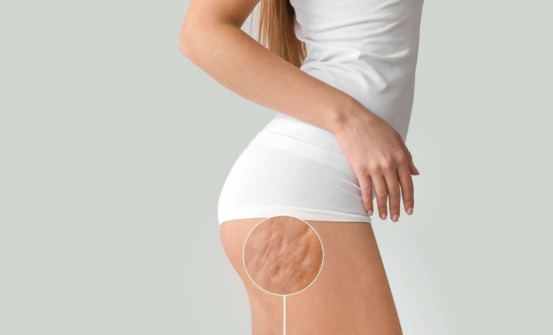 E normal sau nu să ai celulită? Victoria Gorbenco, medic dermatolog: „Majoritatea femeilor, peste 90% au această particularitate a pielii” - VIDEO