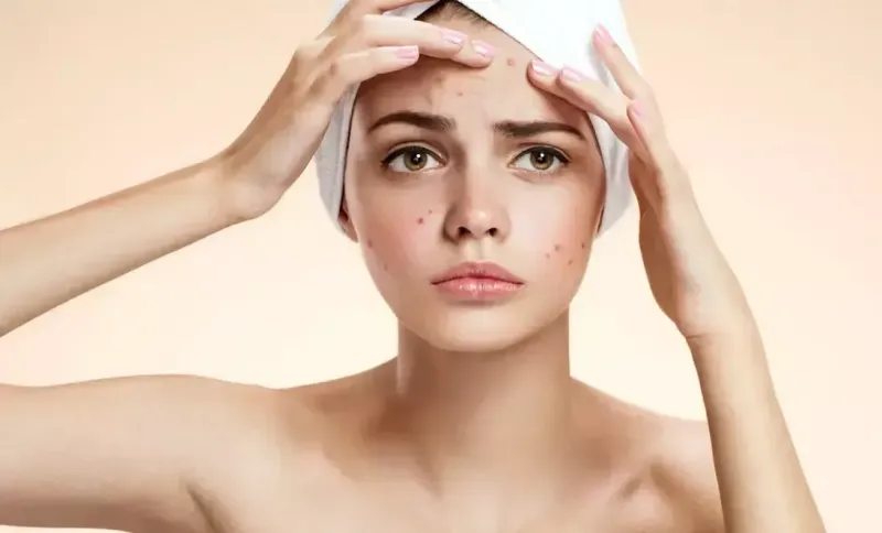 Adevărul dureros despre acnee! Medicul dermatolog Victoria Gorbenco trage un semnal de alarmă - FOTO
