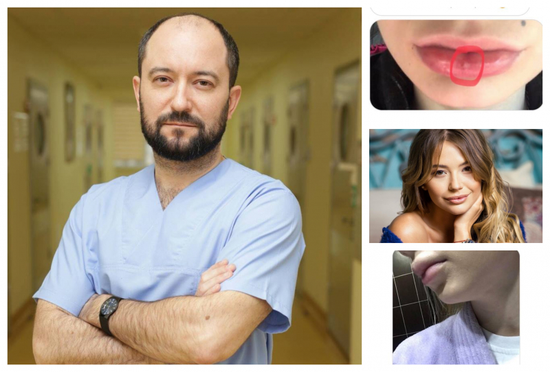Scandalul buzelor din plastic! Medicul Eugeniu Gorosenco atentioneaza: "Dupa injectarea produselor sintetice, organismul apreciaza preparatul ca unul strain si incearca sa scape de el." - FOTO