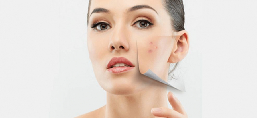 Cum scapam de nesuferita acnee. Pe langa peelingurile chimice, tratamentul acestei afectiuni se poate trata si cu laserul. Victoria Craiu, cosmetolog: „Laserul are doua lungimi de unda, care actioneaza simultan asupra zonei afectate" - VIDEO
