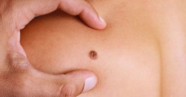 Mai - luna constientizarii cancerului de piele! Dermatologul Irina Batir: "Foloseste creme de protectie solara de cel putin 30 SPF pentru a acoperi pielea expusa, inclusiv iarna"