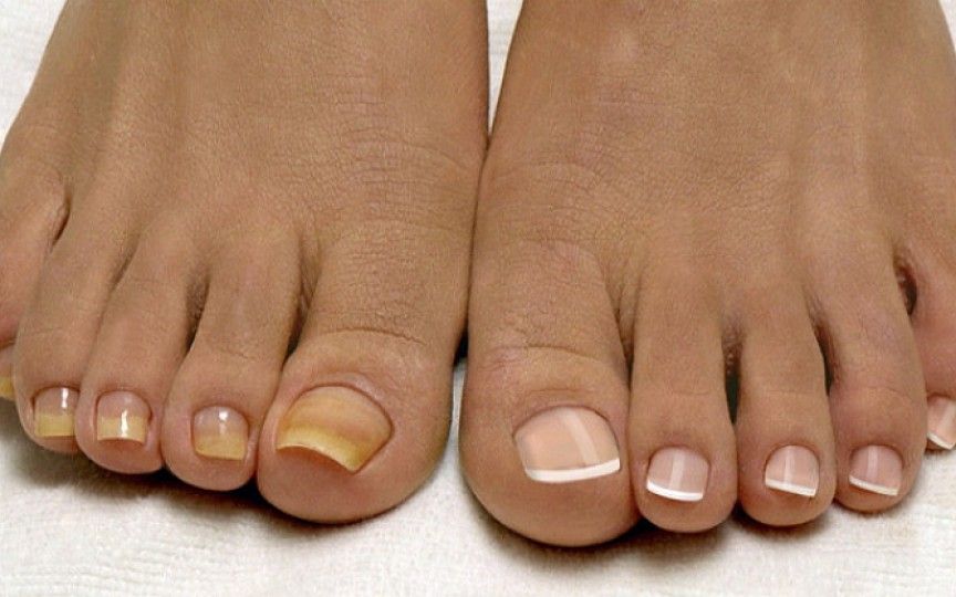 Infecția micotică a unghiei