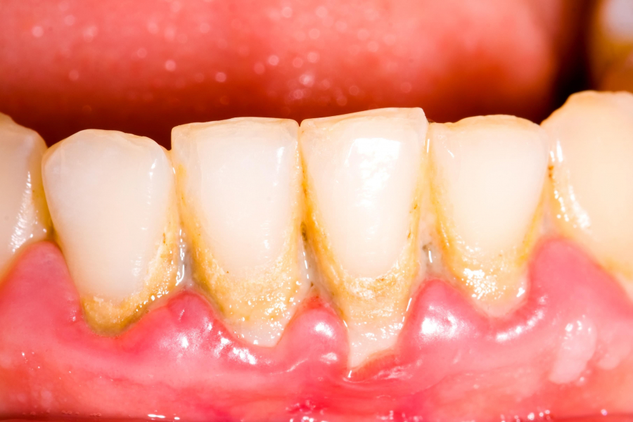 10 alimente si bauturi care duc la formarea tartrului si cariilor dentare
