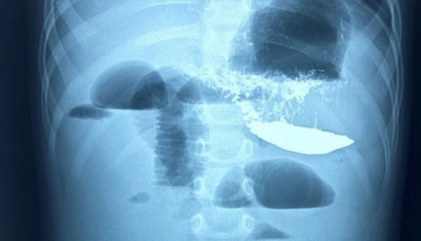Un copil de doi ani - operat cu succes de catre medicii de la Institutul Mamei si Copilului. Ce operatie dificila a suportat acesta