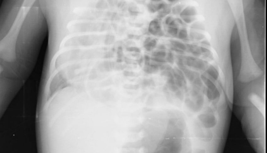 In premiera, medicii de la noi au efectuat o interventie chirurgicala unui nou-nascut diagnosticat cu hernie diafragmatica. Cum se simte copilul