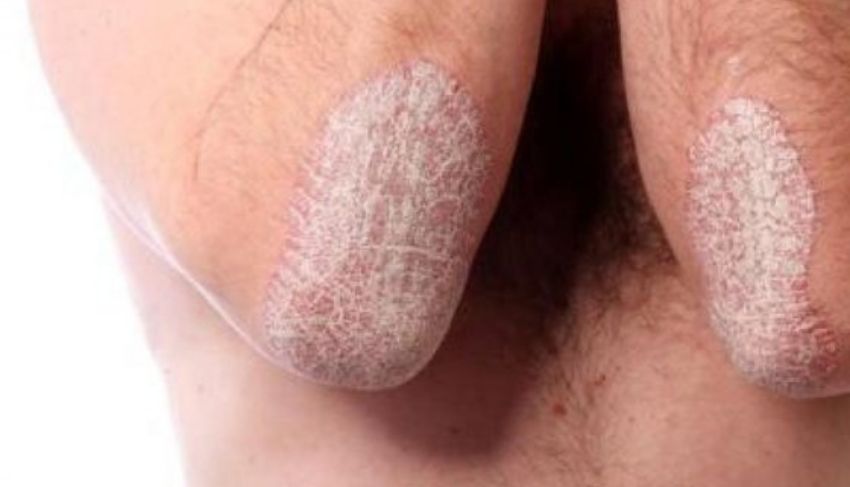 Ziua Mondiala a Psoriazisului. Ce afectiuni poate ascunde boala