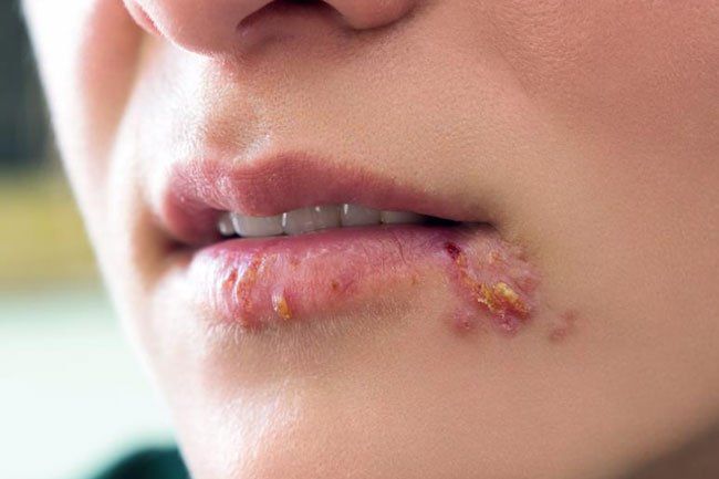 Ce legatura este intre herpes si bolile neurodegenerative?