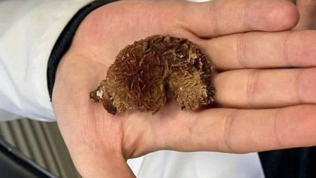 O piatra de 7 centimetri a fost scoasa din rinichiul unui barbat de 43 de ani. Afla cat a durat aceasta operatie? 