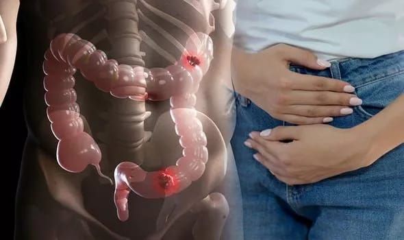 Ce semnale da cancerul colorectal si ce poti face pentru a-l preveni