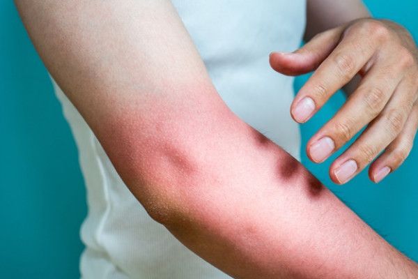Cum poti sa tratezi arsurile solare acasa. Cinci remedii simple si eficiente pentru a calma pielea inflamata si dureroasa