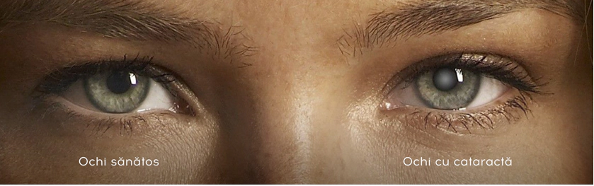 Cataracta