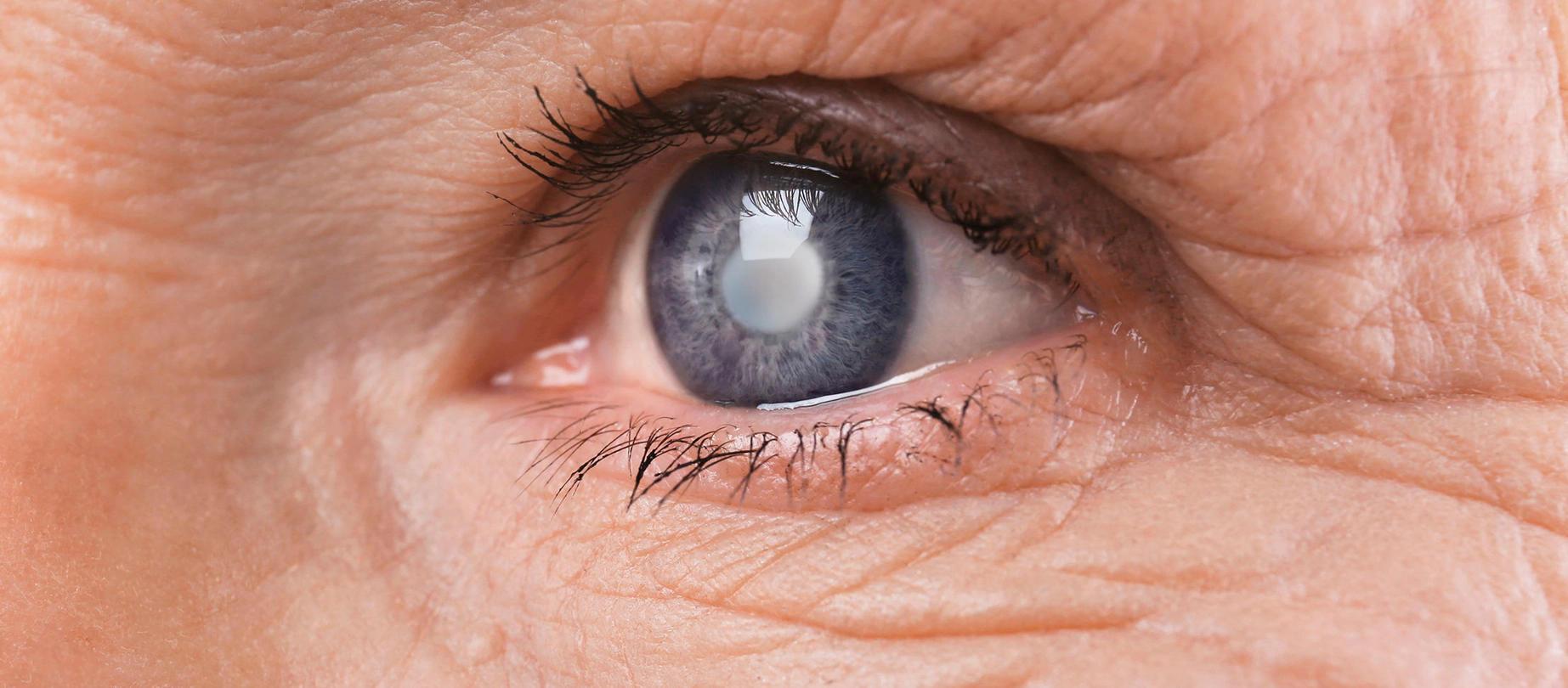  Cataracta