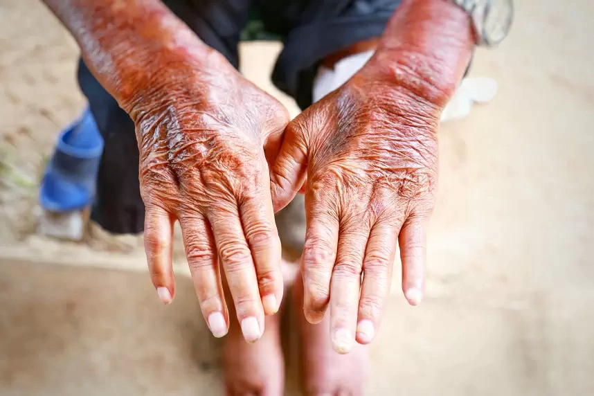 Sclerodermia