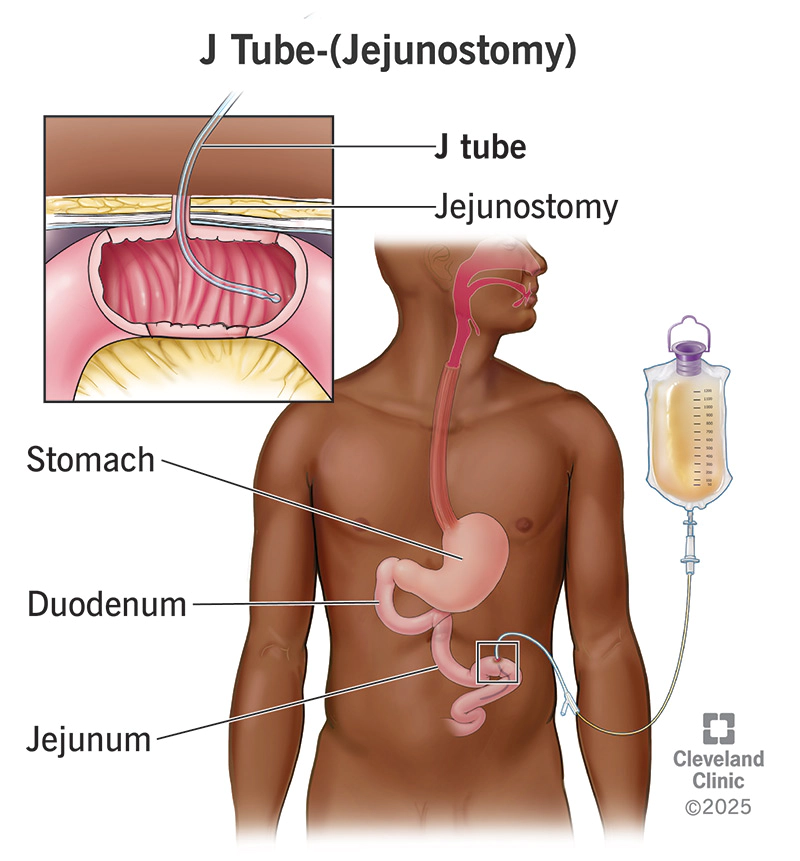 Jejunojejunostomie